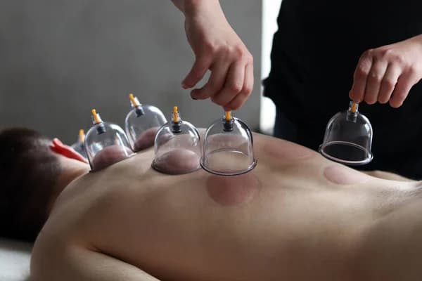 Hijama Therapy